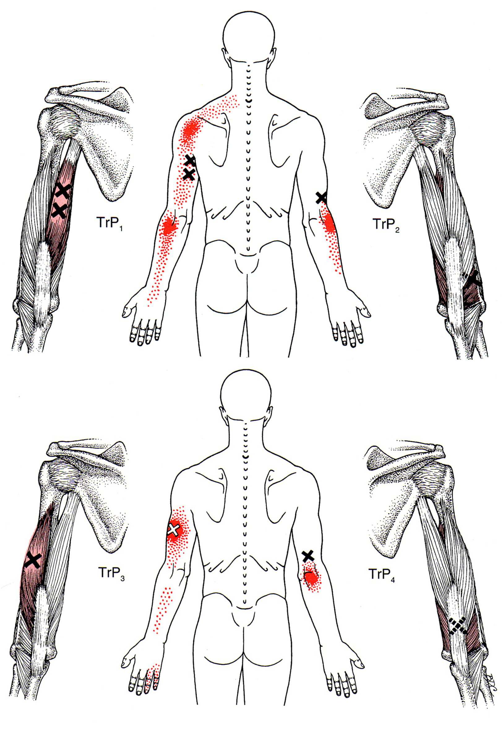 Triceps Brachii The Trigger Point Referred Pain Guide